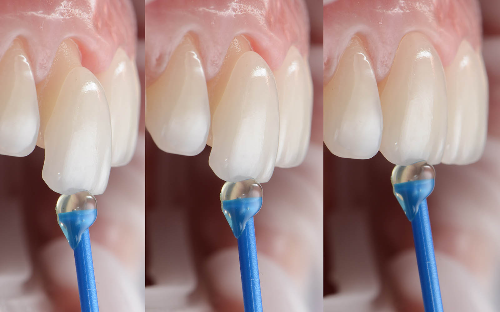 patient-applying-veneer.jpg